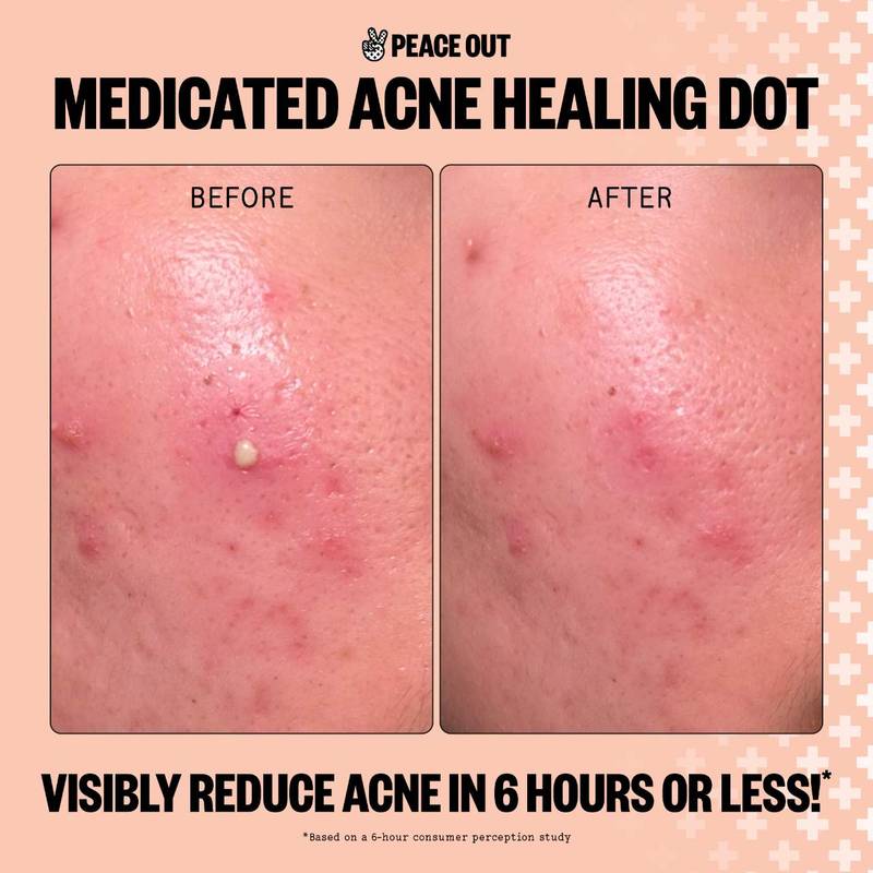 Peace Out Salicylic Acid Acne Healing Dots, 20ct