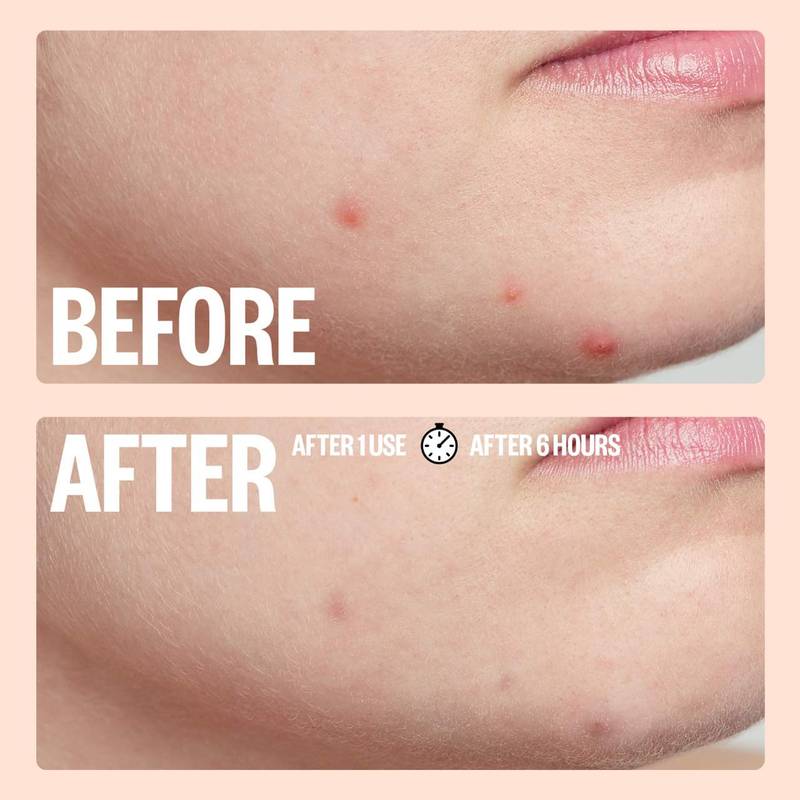 Peace Out Salicylic Acid Acne Healing Dots, 20ct